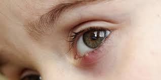stye in the eye symptoms causes