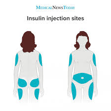 Best Insulin Injection Sites Absorption Time And Rotation