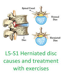 herniated disk in lower back causes and