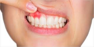 mouth ulcers sores symptoms