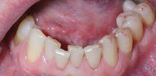 sub mucosal swelling british dental