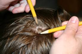 head lice often causes alarm