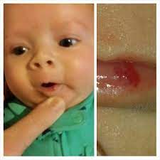 red spot on lip babycenter