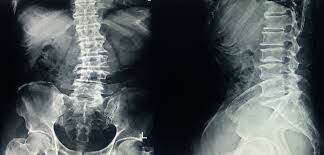 how scoliosis affects life for elderly