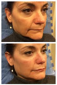 rha fillers before and afters