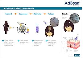 stem cell therapy for hair restoration