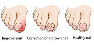 ingrown toenail my skin clinic qld