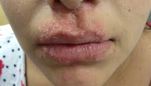 derm dx itchy lesions around the lips