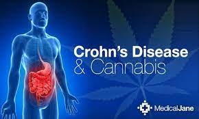 Cannabis and crohns disease