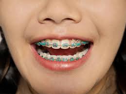 Smile changes after molar extraction. Braces With Rubber Bands Purpose And How Long They Stay On
