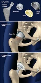 total hip replacement anterior