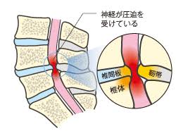 「脊柱管狭窄症 フリー」の画像検索結果