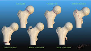 proximal fem fractures symptoms