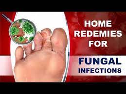 how to cure fungal infection using home