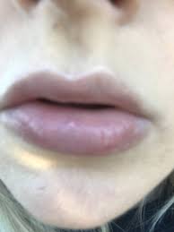 bottom lip 1 month after lip fillers