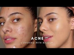 how to cover acne with makeup base