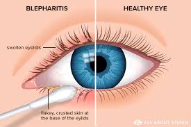 blepharitis causes symptoms and treatment