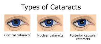 Cataracts Thorndale Pa Custom Cataract Berwyn Levin Luminais