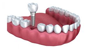 How Long Is The Dental Implant Healing Period Before Crown Placement? | Platinum Dental Care