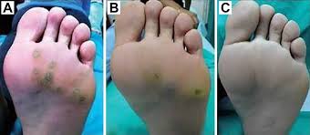 plantar warts epidemiology