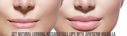 juvederm volbella lip injection in