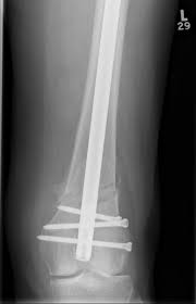 distal femur fractures the bone