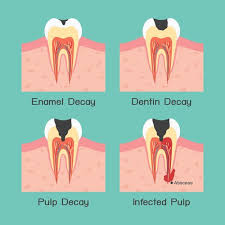 symptoms of an abscessed tooth duff