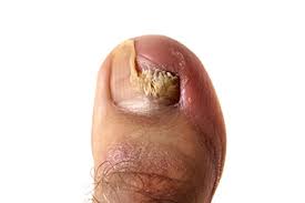 the early ses of toenail fungus