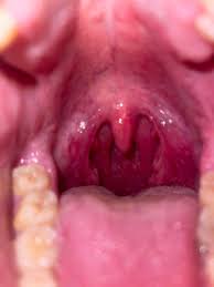Recognize your risk for throat cancer. Vfiziqnzen621m