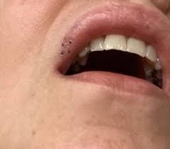 dermdx bothersome spots on lips