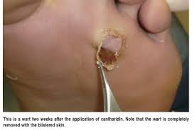 Plantar warts are painful warts on the sole of the foot. Current Concepts In Managing Plantar Warts Podiatry Today