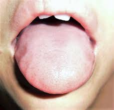swollen tongue thyroid before i was