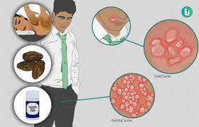 herpes symptoms causes treatment
