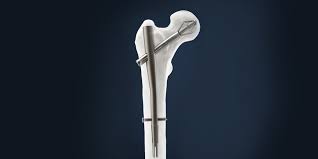 femur fracture fixation nailing system