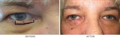 Learn about the academy's efforts to refocus its brand on education. Eyelid Skin Cancer Excision Before And After Photo Gallery