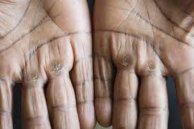 hand calluses how to fix them