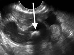 Both women and men can get pelvic ultrasounds, but it's more common for women to get them. Unexpected Findings During Evaluation Of Acute Pelvic Pain With Transvaginal Sonography Ohngemach 2016 Journal Of Ultrasound In Medicine Wiley Online Library