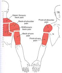 Upper Back Shoulder And Arm The Trigger Point Referred