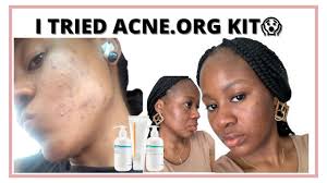 how to use acne org benzoyl peroxide to