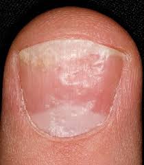 thick toenails diagnosis treatment