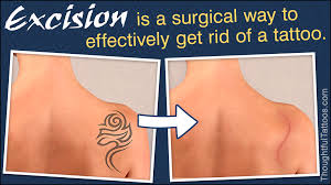 What are the methods of tattoo. Tattoo Removal Cost Thoughtful Tattoos