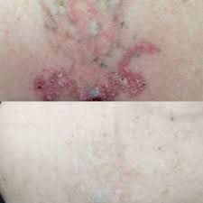 laser tattoo removal specialists in