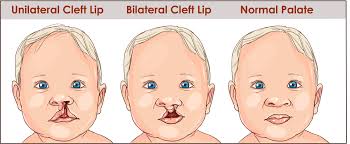 cleft lip and palate what it is and