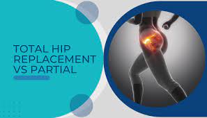 total hip replacement vs partial dr