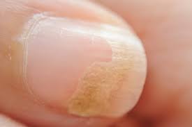 nail fungus infection