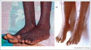 Monkeypox outbreak confirmed in uk as cases under investigation. A Legs And Feet Of Monkeypox Patient Photo Courtesy Of J Harvey Download Scientific Diagram