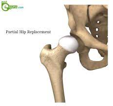 partial hip replacement procedure