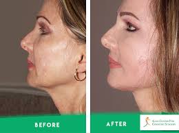 compression after facelift surgery