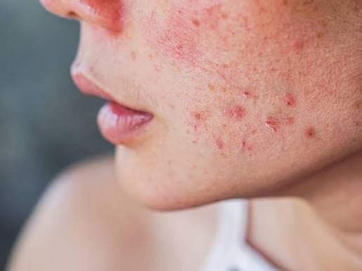 Da mặt bị dị ứng nổi sần ngứa phải làm sao?