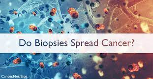 does cancer spread faster after biopsy